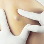 Doctor Diagnosis of the Sebaceous on Woman's Back